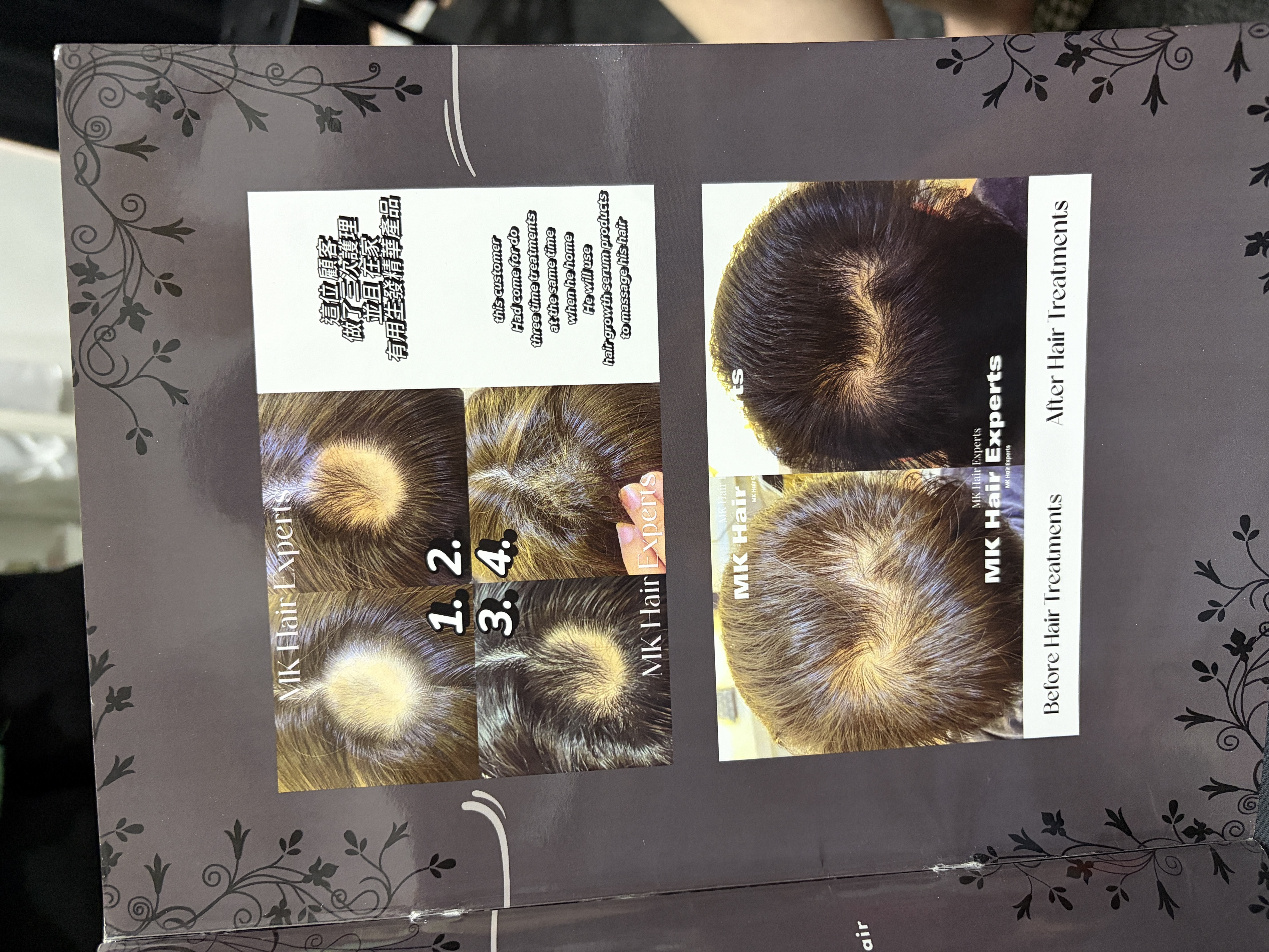 Real MK Hair Expert client hair and scalp progress photographs